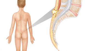 Pilonidal Sinus