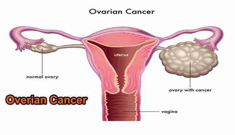 Ovarian Cancer