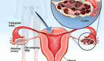 POLYCYSTIC OVARIAN SYNDROME