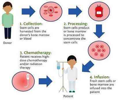 bone marrow Allogenic transplant