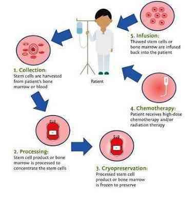 bone marrow Autologous transplantation