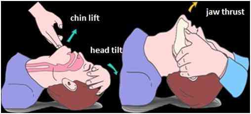 Head tilt chin lift position for airway maintenance