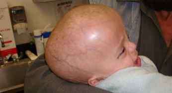 20 Best Government and Private Hospitals for Hydrocephalus or Jalshirsh treatment in India