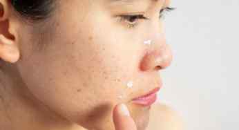 5 effective home remedies to get clear and acne-free skin