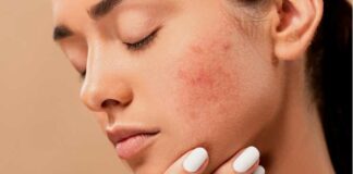 Acne, Pimples, Spots, Zits, Skin, Female, Face