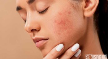 Facts about Acne on Face and their Solutions