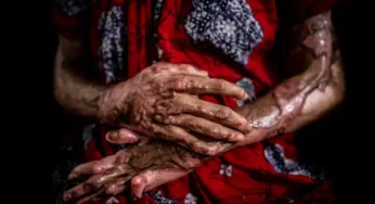 Challenges Faced by Acid Attack Survivors in India: Insights from 5 Real-Life Cases